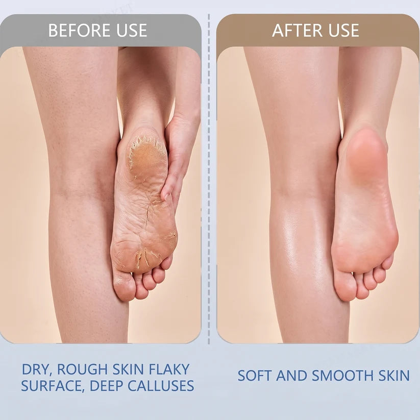 Electric Foot File – Rechargeable Callus Remover | AuriGlam
